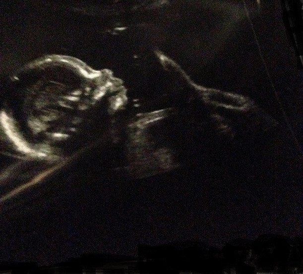 Акушер убила многодетную мать во время аборта